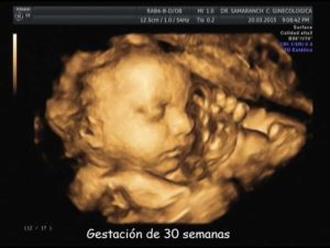 3-eco-3d-feto-de-30-semanas