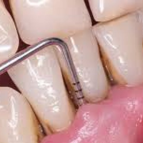 Periodoncia