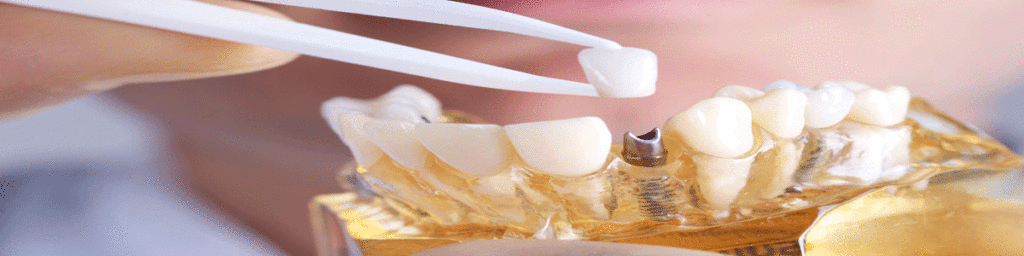 Clinica Dental Ulident – Ciudad Lineal