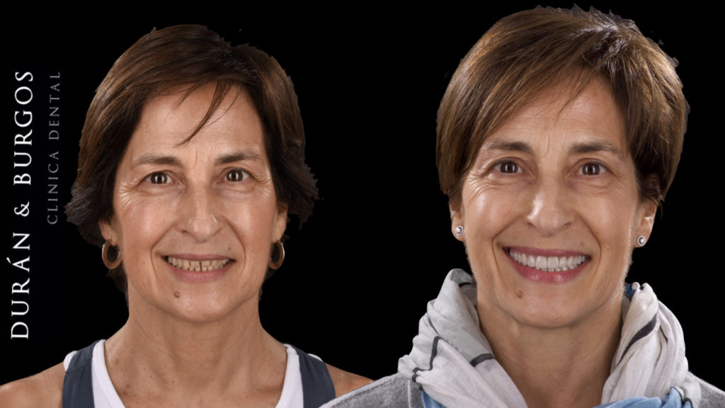 antes-despues.041