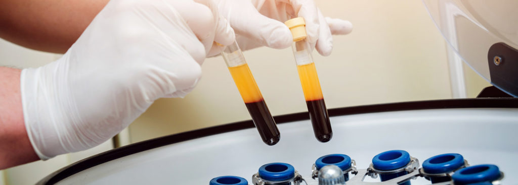 bioestimulacion_plasma_rico_plaquetas