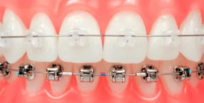 boca-brackets-ortodoncia-1