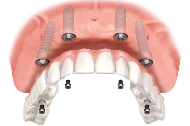 dental-protesis-800&#215;533