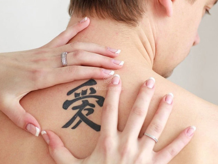 eliminacion-de-manchas-y-tatuajes_ci3