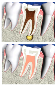 endodoncia-195x300