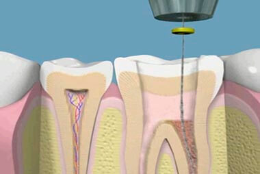 endodoncia-2