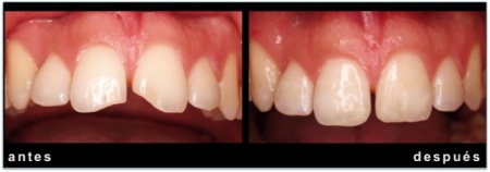 fractura-incisivos-composite-2-450x158okk