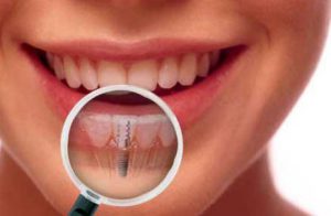 implante-dental-en-clinica-300&#215;196