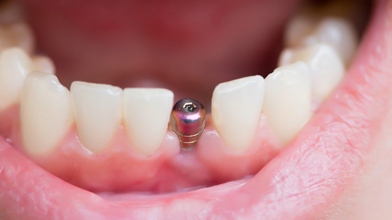 implante-dental
