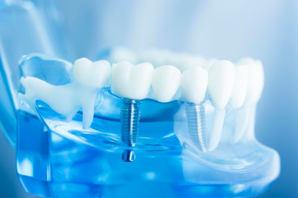 implantes-1024&#215;682
