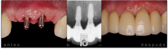 implantes-4-icisivos-705x206