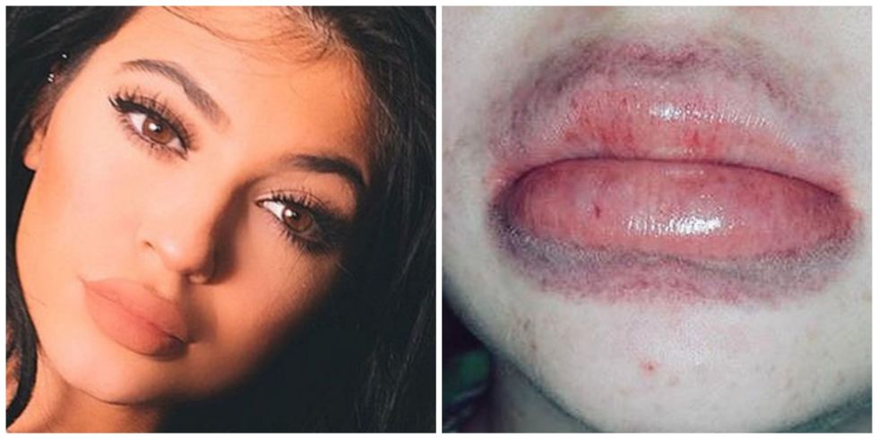 kylie_jenner_labios