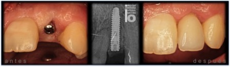lateral-implante-450x132
