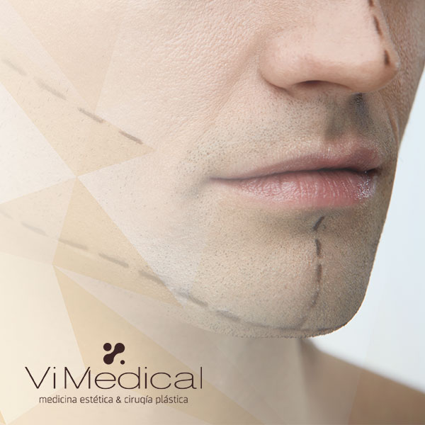 mentoplastia-vimedical