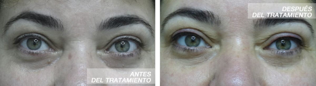 micropigmentacion-ojos-madrid