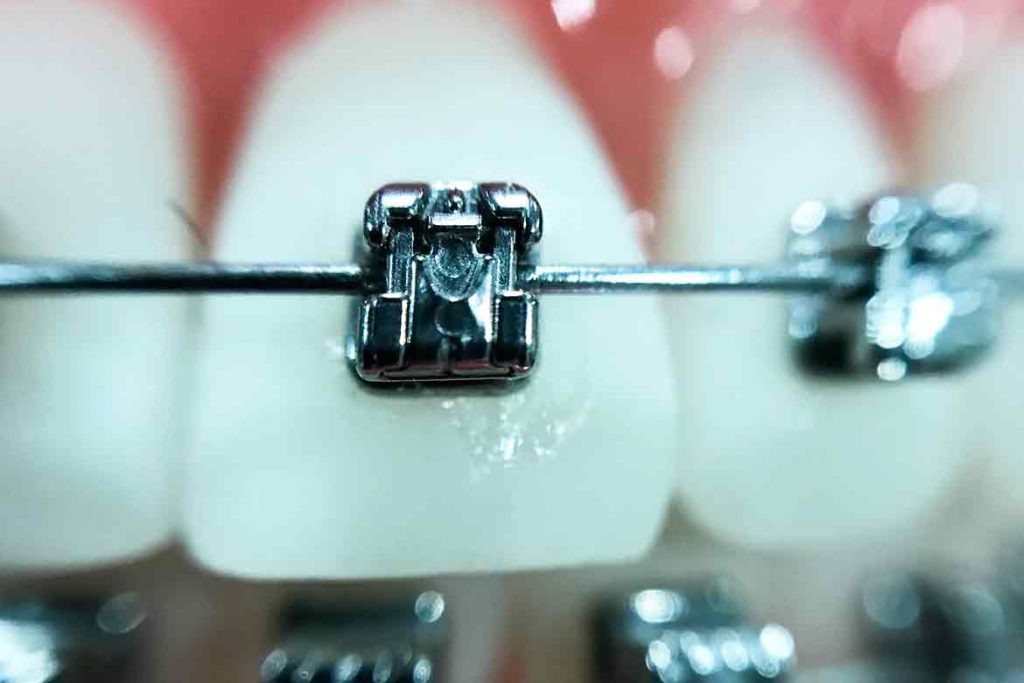 ortodoncia-bracket-1024&#215;683