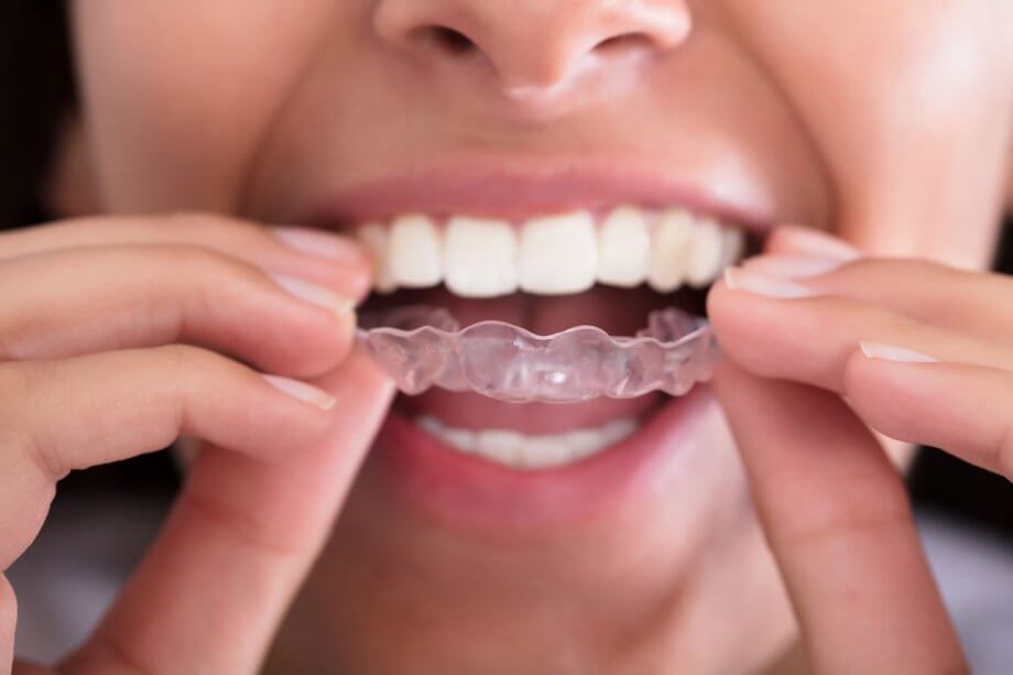 ortodoncia-invisble-invisalign