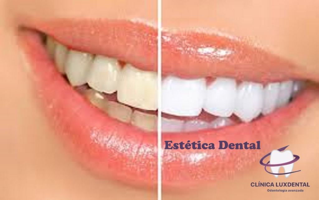 lux-dental-malvarrosa-luxdentalmalvarrosa-estetica-dental