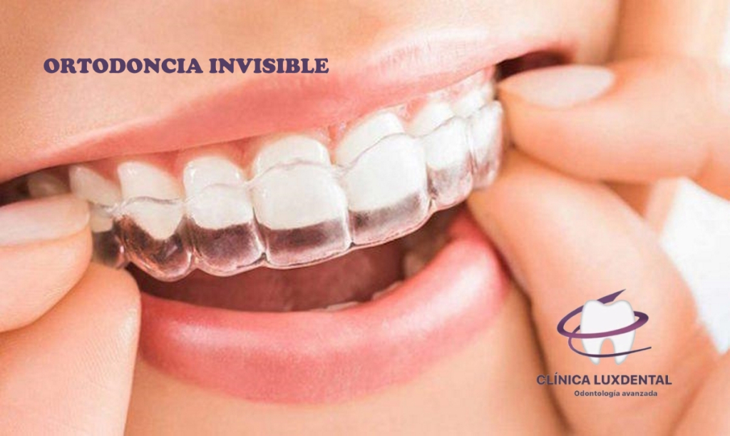 lux-dental-malvarrosa-luxdentalmalvarrosa-ortodoncia-invisible