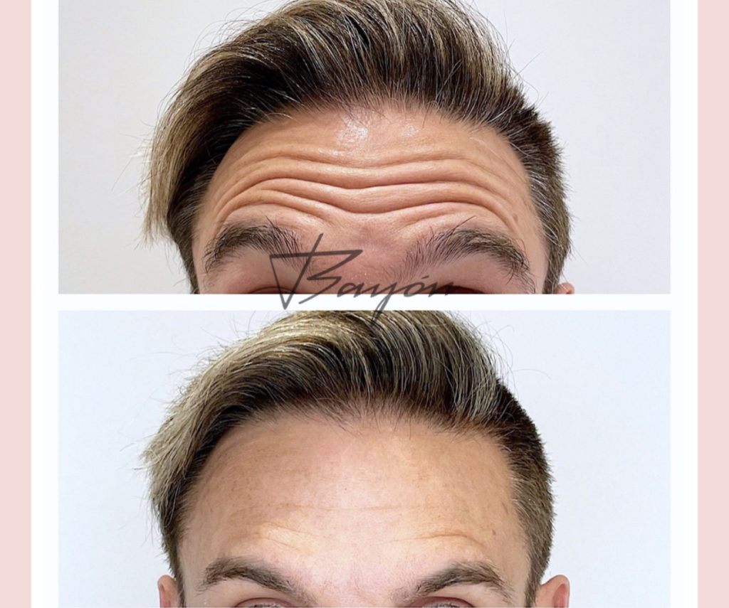 Botox