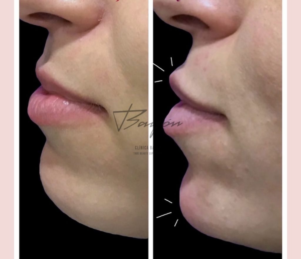 mesoterapia facial