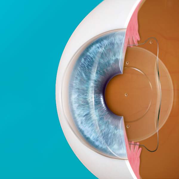 lentes-ICL-clinica-oftalmologica-cliniteco