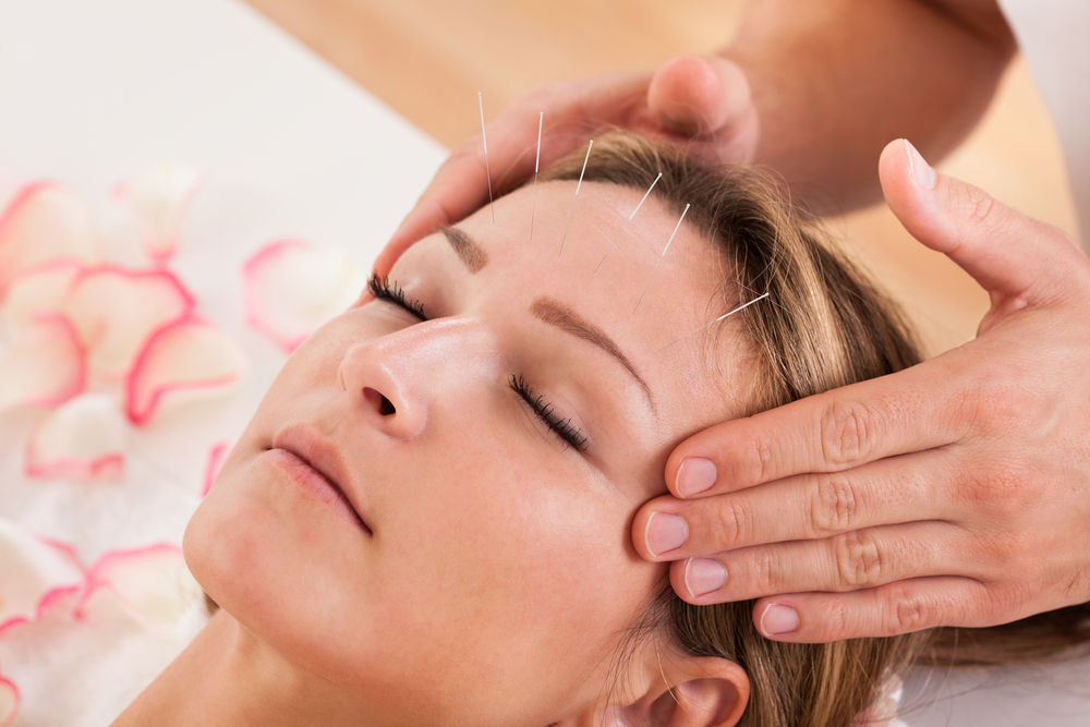 Woman,Undergoing,Acupuncture,Treatment,With,A,Line,Of,Fine,Needles