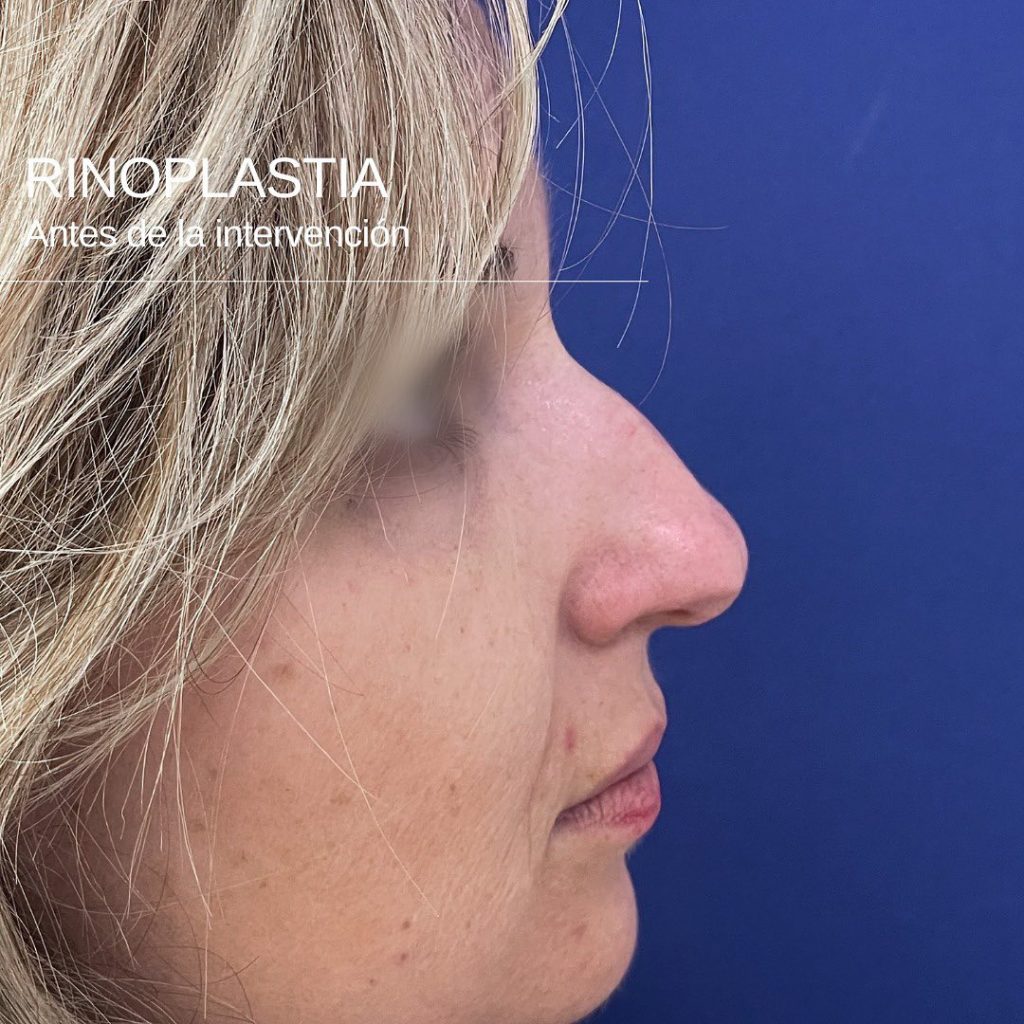 Rinoplastia antes de la intervención-Dr. Mallet cirugía estética en Valencia