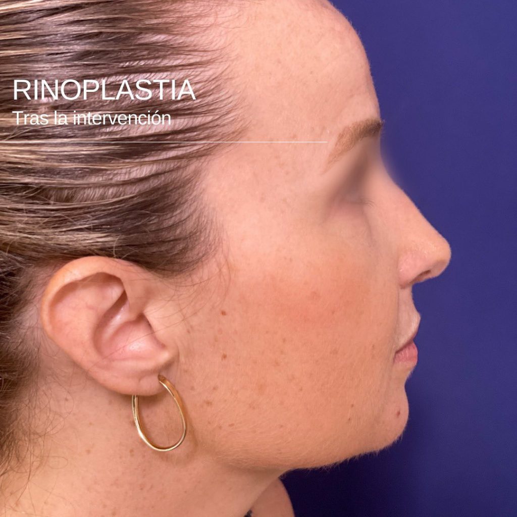 Rinoplastia tras la intervención-Dr. Mallet cirugía estética en Valencia