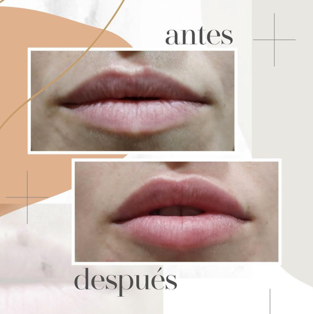 hidratación labial antes y despúes-Dr. Mallent Cirugía estética en Valencia