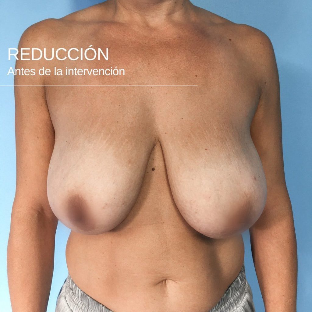 reducción de mamas antes de la intervención-Dr. Mallent cirugía estética en Valencia