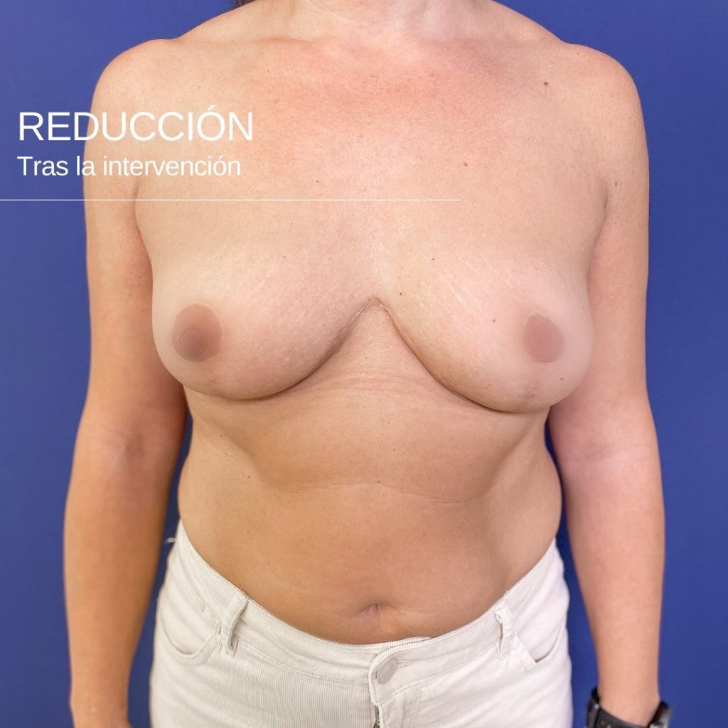 reducción de mamas tras la intervención-Dr. Mallent cirugía estética en valencia