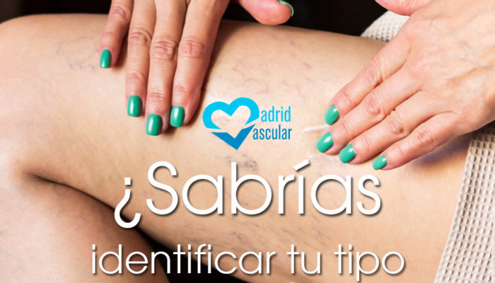 seccion tipos de varices