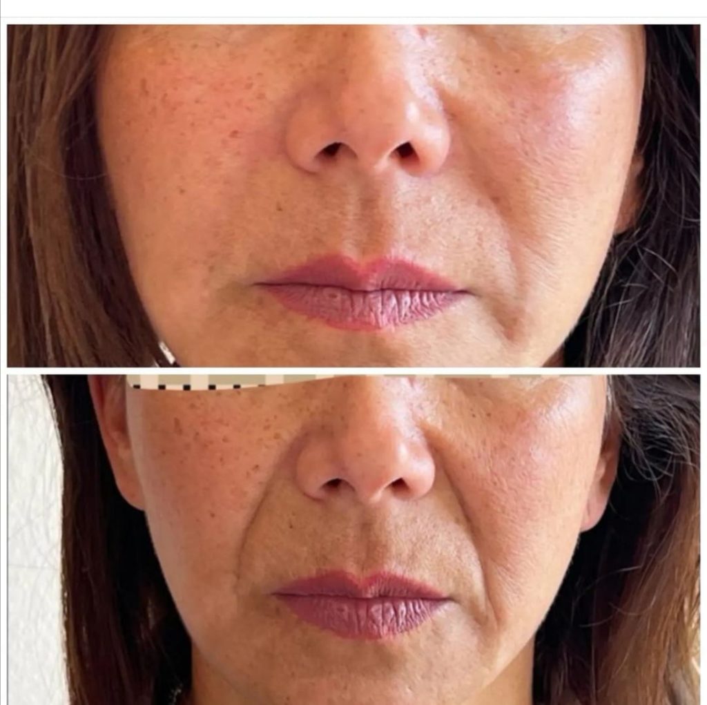 Antes y después-Ac Medicina Estetica