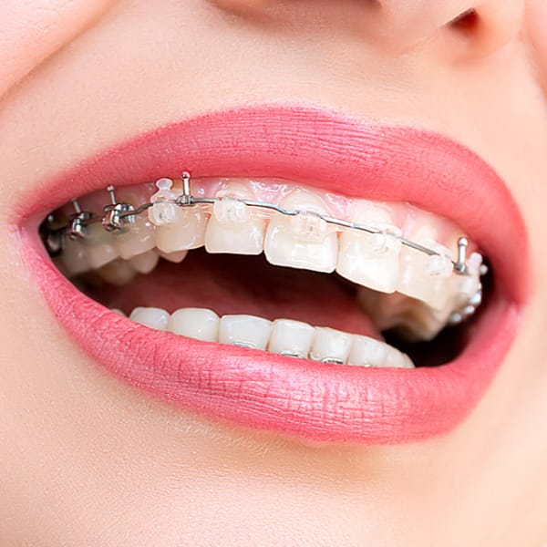 brackets-esteticos
