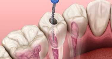 tratamientos-endodoncia-377&#215;200